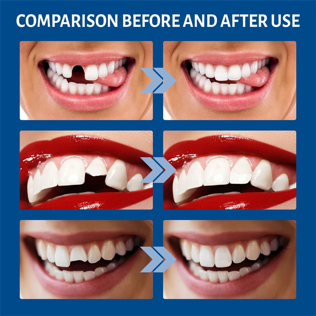 Tooth Repair Glue Shapeable Teeth Gaps Filling Solid Glue Temporary Teeth Repair Falseteeth Glue Safety Dental Supplies