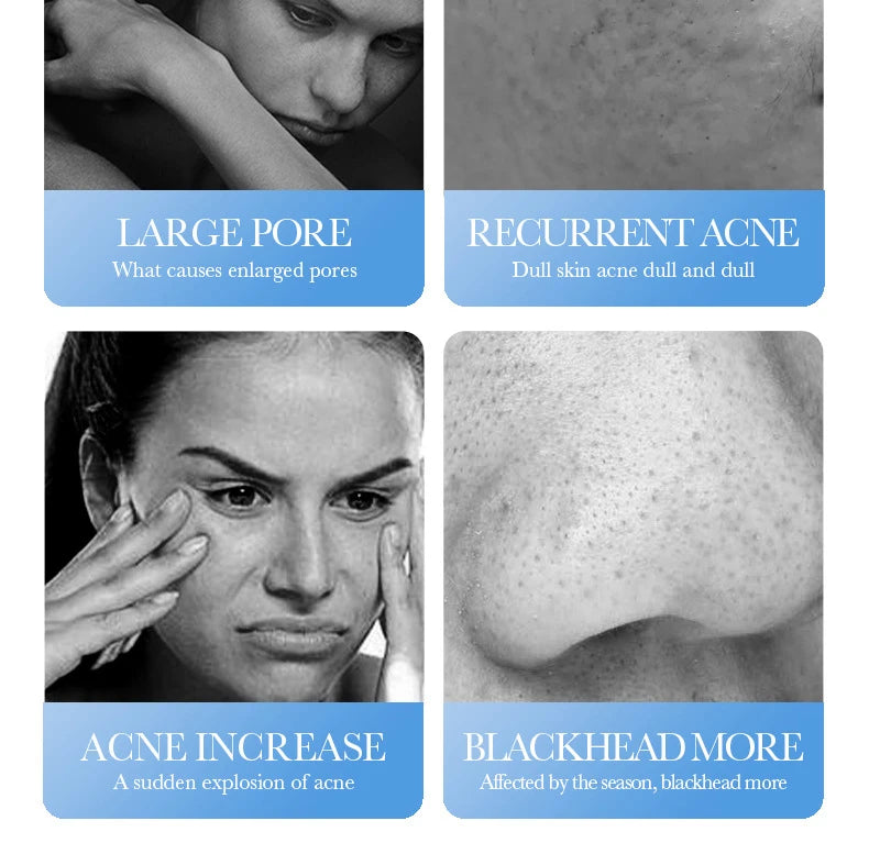 Salicylic Acid Blemish Repair Face Cream – Acne, Blackheads & Pore Refining